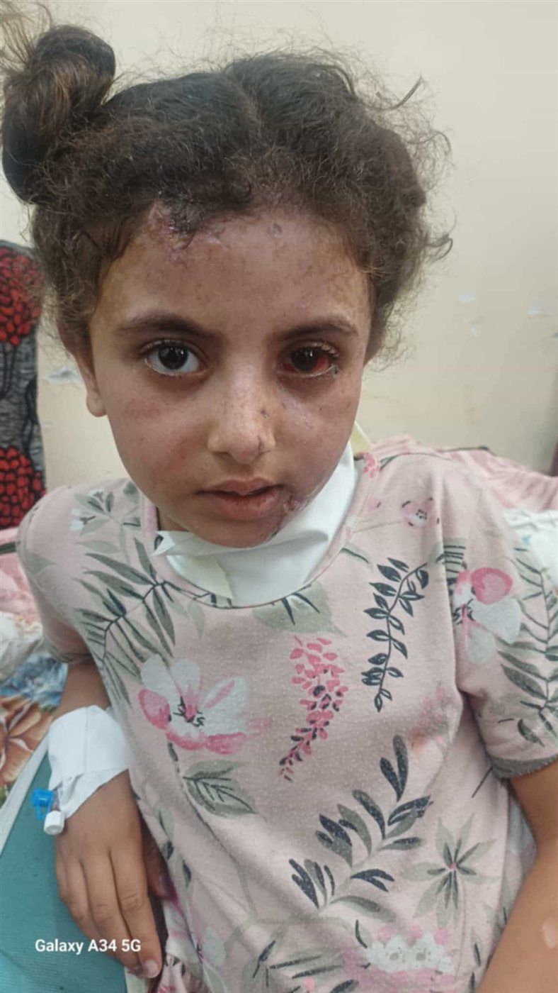 مياس بعد الإصابة