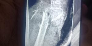 مستشفى الفيوم العام تنقذ حياة سيدة مسنّة بعد سقوط من علو وتجري جراحة ميكروسكوبية دقيقة باليد