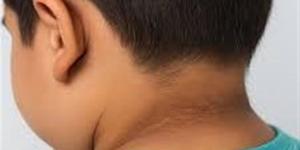 اسمرار الرقبة وتحت الإبط عند الأطفال: علامة صحية لا يجب تجاهلها