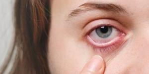 الصحة العالمية: الجزائر تقضى على التراكوما المسبب للعمى كمشكلة صحية عامة