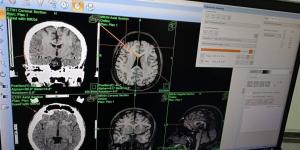 تقنية جديدة لعلاج الصرع في مستشفيات دمياط الحكومية