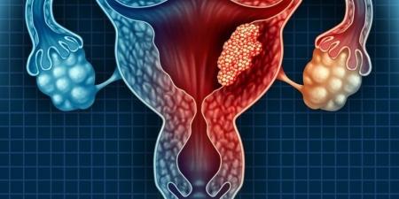 الأعراض الأولى لسرطان عنق الرحم