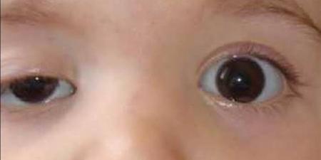 تقنية جديدة قد تعالج كسل العين بعد سن التسع سنوات وتعيد تنشيط الرؤية