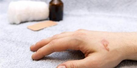 هل يُعالج "بياض البيض" الحروق؟.. حسم الجدل بشأن "الأسطورة الشائعة"