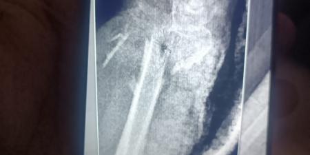 مستشفى الفيوم العام تنقذ حياة سيدة مسنّة بعد سقوط من علو وتجري جراحة ميكروسكوبية دقيقة باليد