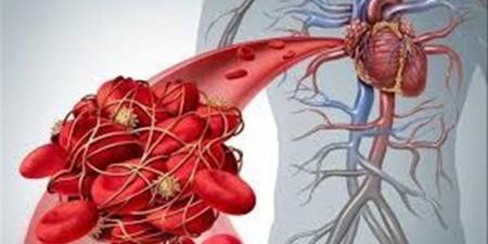 عادة يومية بسيطة ترفع خطر الجلطات دون أن تشعر.. اعرفها