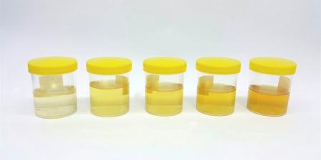 كيف يكشف لون البول عن حالتك الصحية؟