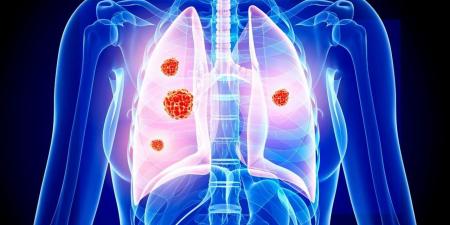 العلماء يحددون آلية تربط "كوفيد-19" بسرطان الرئة