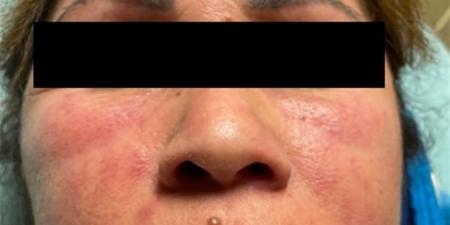 صيحة مكياج رائجة تتسبب في إصابة امرأة بمرض نادر