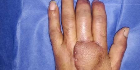 جراحة نادرة بمستشفى المحلة العام لترميم كف يد مريض