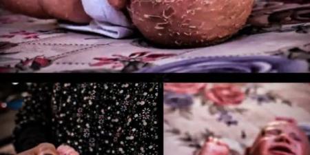 من فقدان شقيقها لمعركة الحياة.. الرضيعة أيسل الهمص تواجه مرضا وراثيا نادرا في غزة