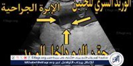 أربعةجلسات لنقل الدم داخل الرحم تنقذ جنينا من أنيميا حادة بمستشفى صحة المرأة بجامعة أسيوط