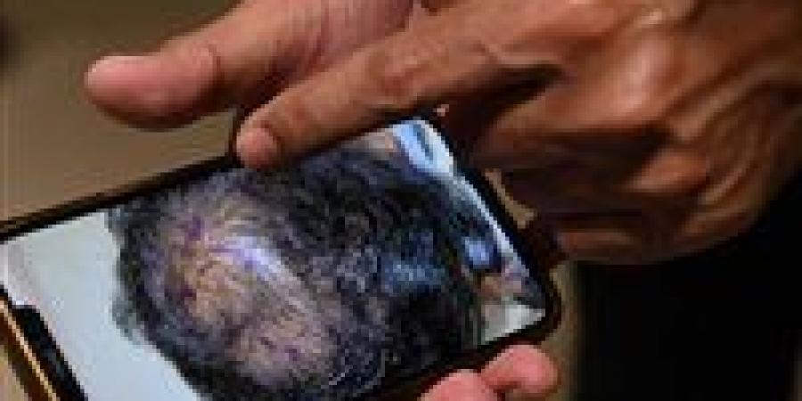 مصل جديد يعيد الأمل لملايين المصابين ب تساقط الشعر خلال 20 يوما