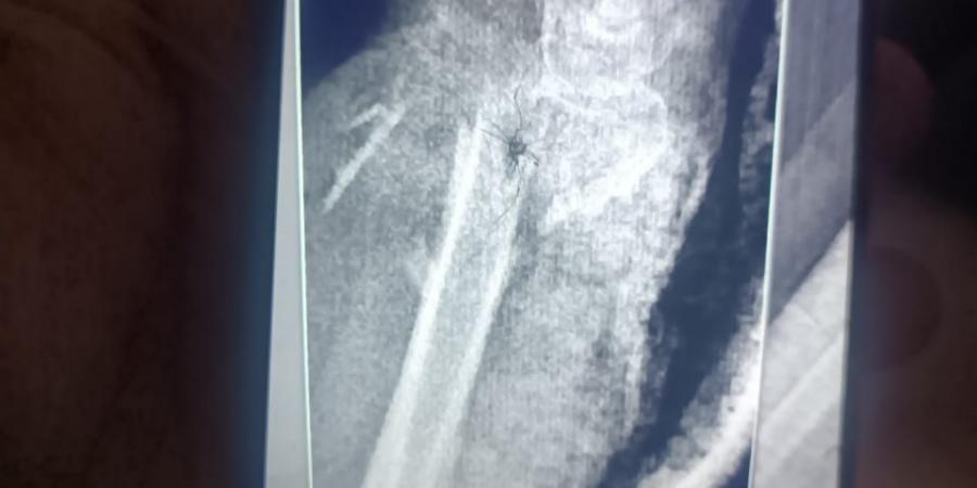 مستشفى الفيوم العام تنقذ حياة سيدة مسنّة بعد سقوط من علو وتجري جراحة ميكروسكوبية دقيقة باليد