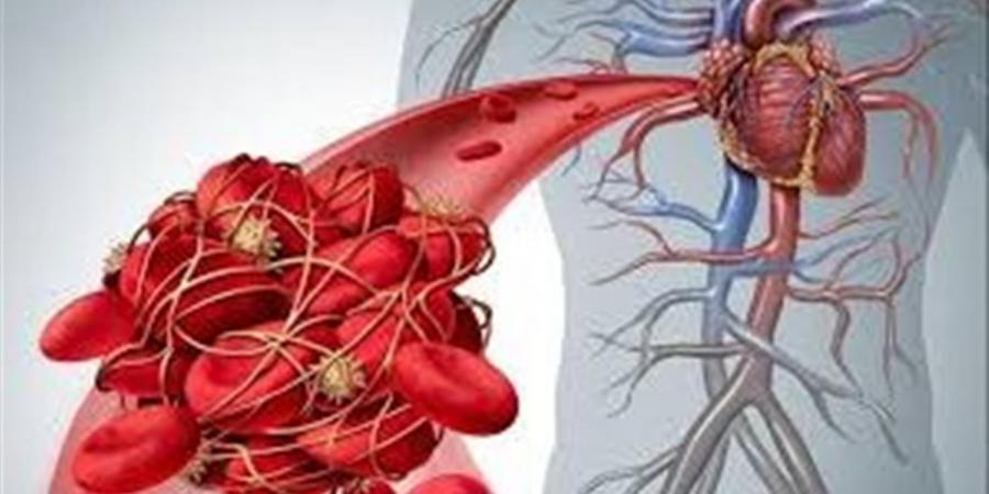 عادة يومية بسيطة ترفع خطر الجلطات دون أن تشعر.. اعرفها