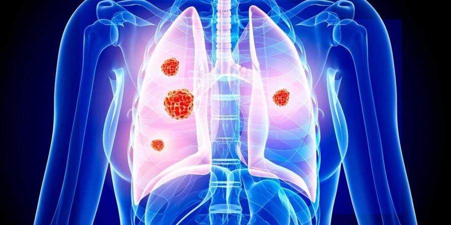 العلماء يحددون آلية تربط "كوفيد-19" بسرطان الرئة