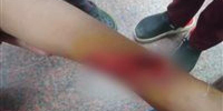 إصابة تلميذ بـ18 غرزة بعد التعدي عليه بزجاجة أمام مدرسة البساتين في الفيوم