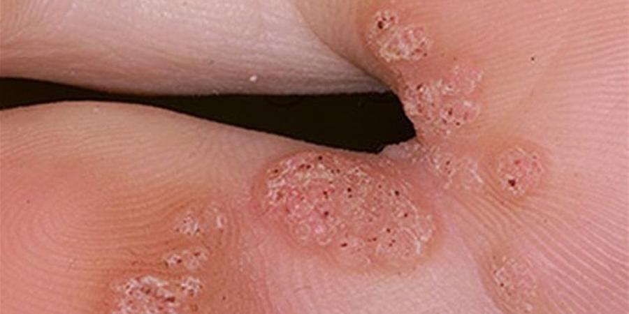 فيروس الورم الحليمي البشري بين العدوى الصامتة وخطر الإصابة بالسرطان