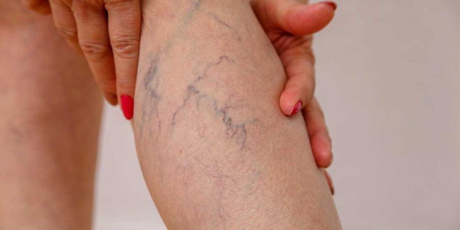 تورم وألم مفاجئ في الساق.. علامات الجلطات الوريدية لا يجب تجاهلها