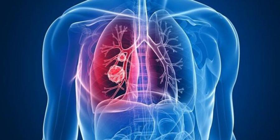 في اليوم العالمي للرئة، الصحة العالمية تكشف أعراض سرطان الرئة وطرق التشخيص والعلاج