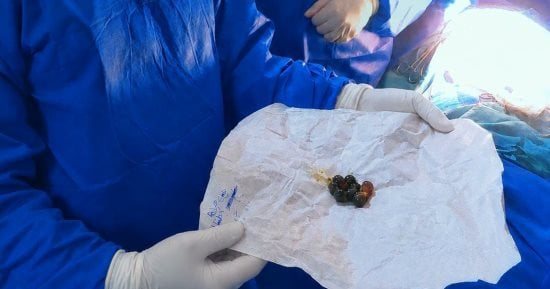 مستشفى كفر الشيخ العام ينقذ طفلة ابتلعت 15 قطعة مغناطيس دون فتح الأمعاء.. صور