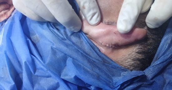 أطباء مستشفى بلبيس المركزي ينجحون في إعادة زرع أذن شاب تعرضت للبتر بحادث طريق